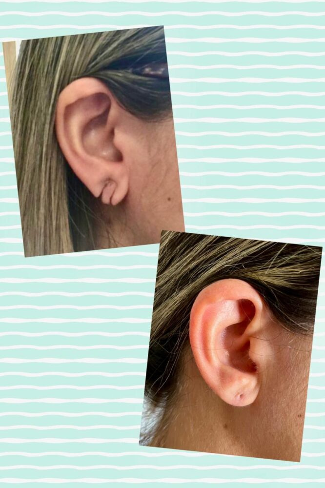 É frequente a ruptura do lóbulo da orelha ou alargamento do orifício pelo uso de brincos pesados ou trauma por tração. A correção, ou lobuloplastia, pode ser realizada em consulatório sob anestesia local, com excelente resultado cirúrgico.